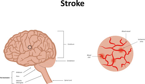 He's having a stroke - here are the signs to look for