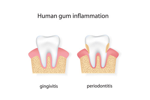 Your dentist can help you prevent a heart attack